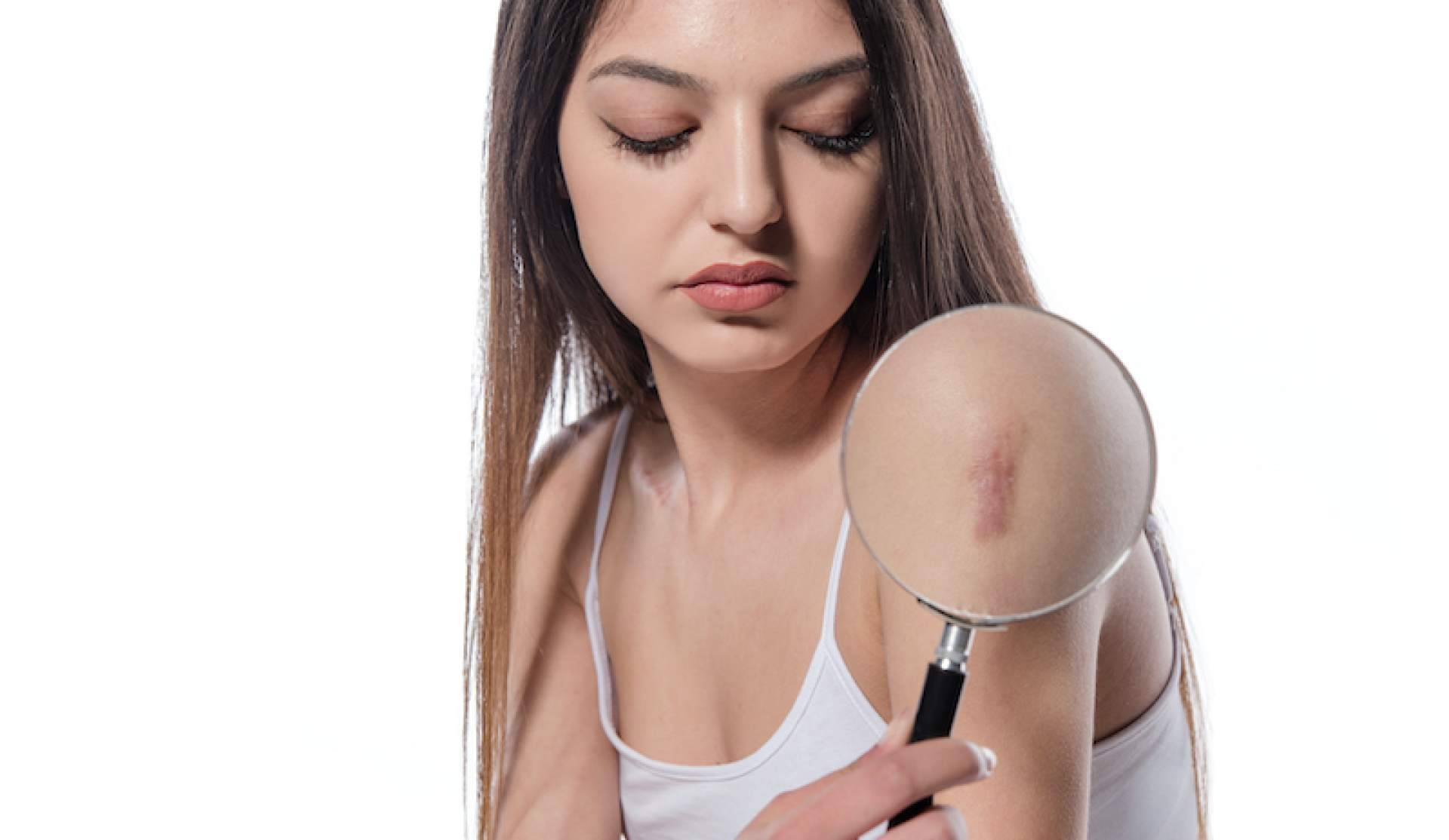 Las ventajas de recurrir a tratamientos para eliminar cicatrices, con Centro Estética el Pilar