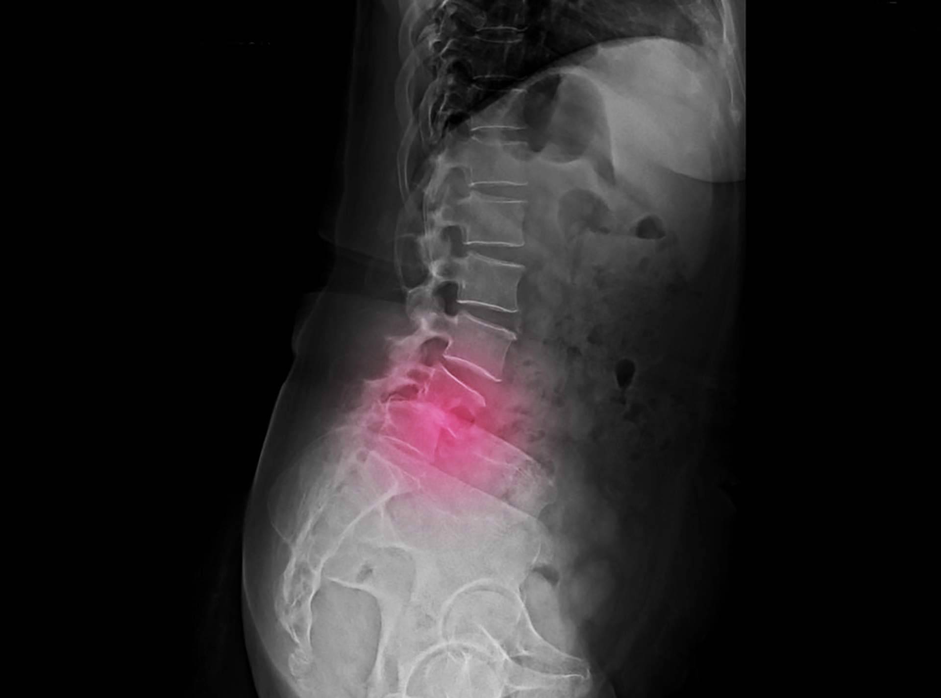 iXalud explica las causas de la espondilolistesis