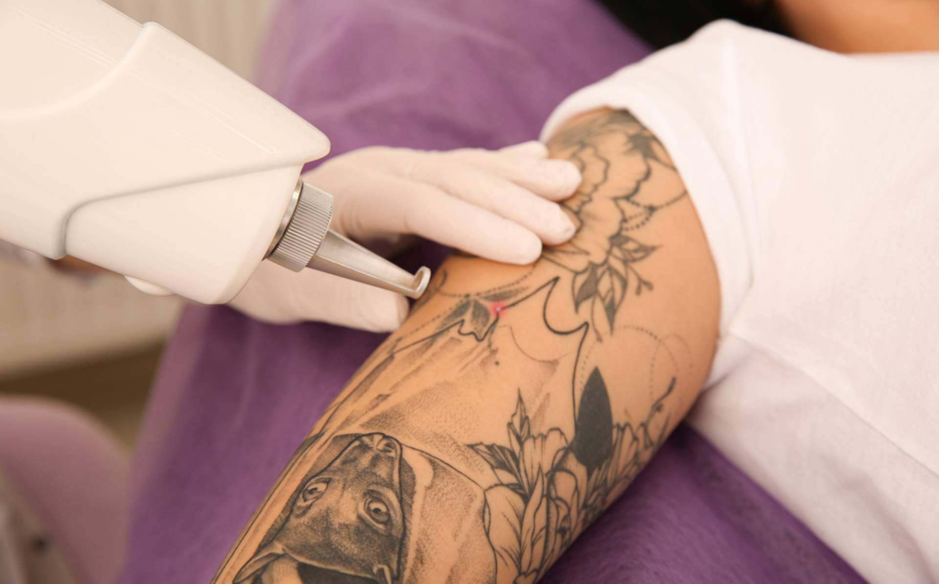 Eliminar tatuajes a color ya es posible en Ink Láser Alicante