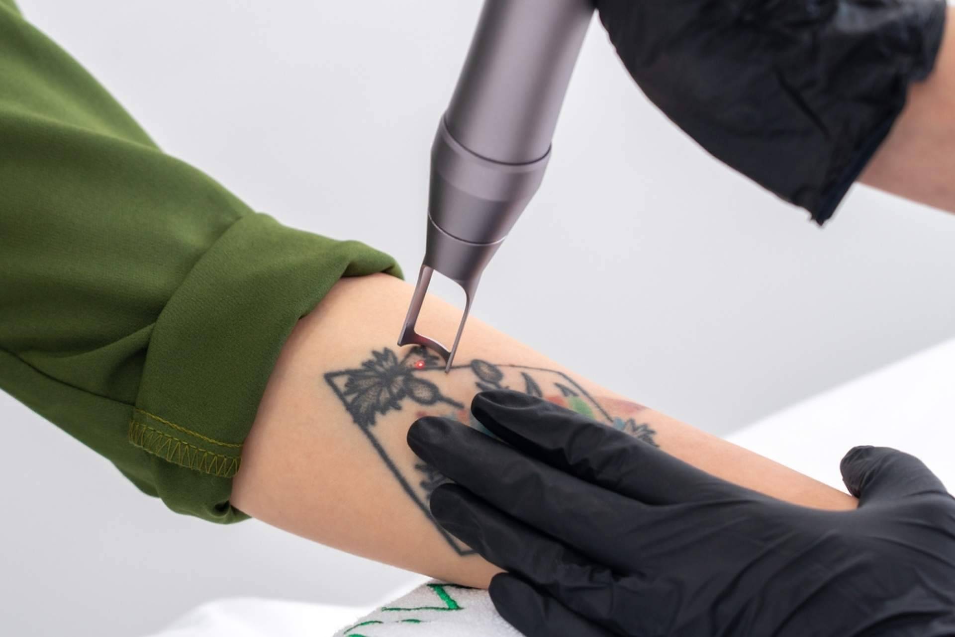 Ink Láser cuenta con tecnología avanzada para borrar tatuajes en Alicante