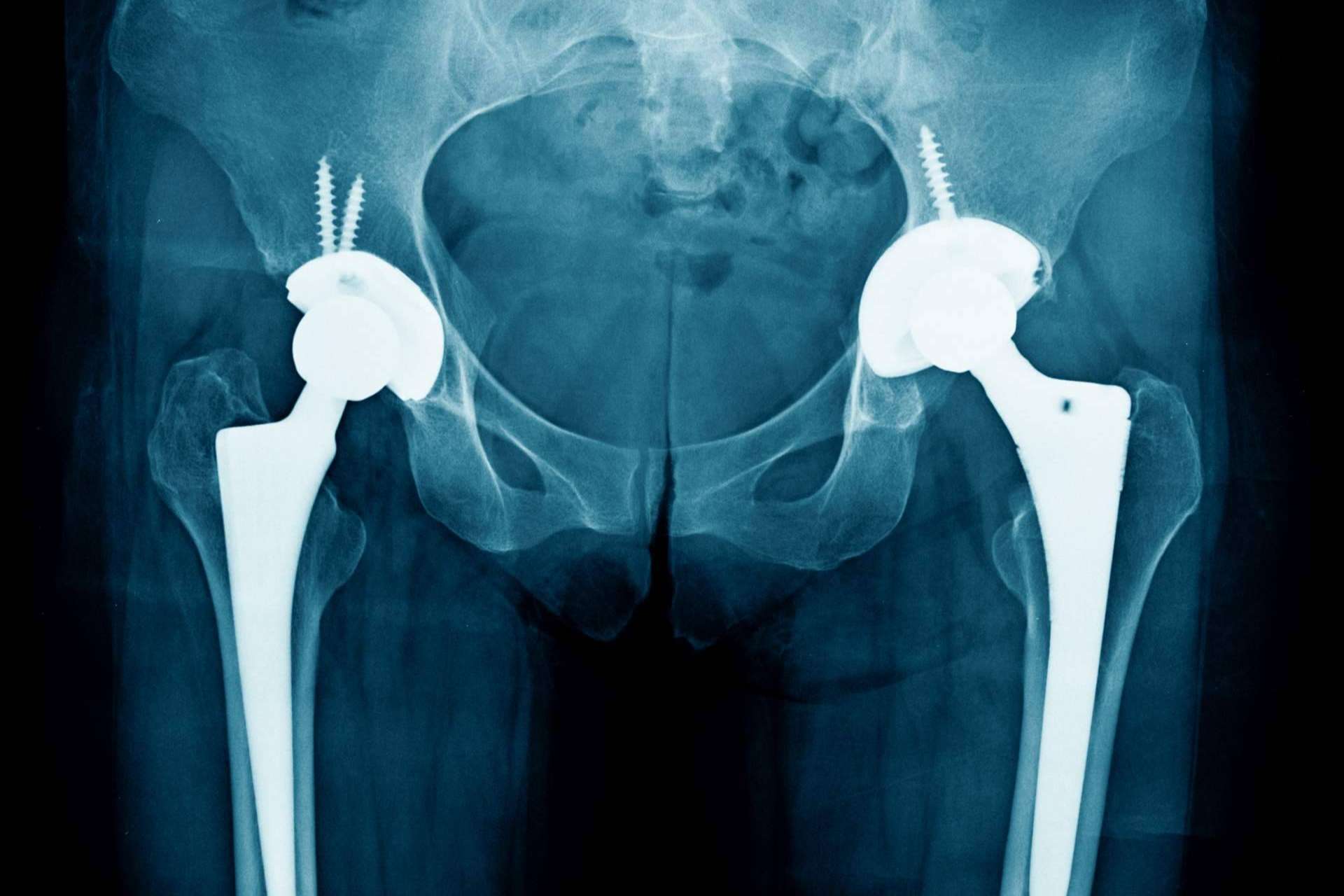 Comprender el dolor y dar inicio al tratamiento de la artropatía degenerativa con iXalud