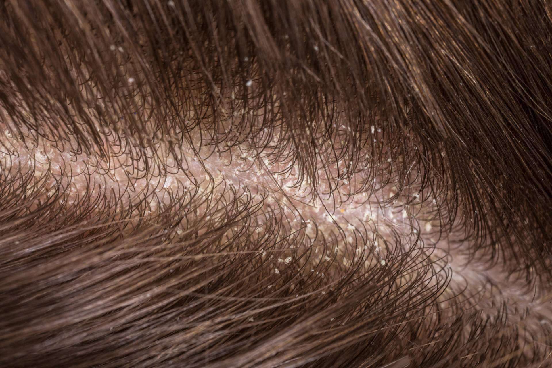 Los beneficios de realizarse un peeling capilar con Malecare