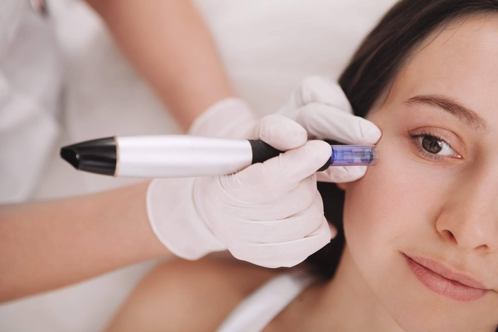 Tratar pequeñas cicatrices y mejorar el aspecto de la piel usando dermapen de G&G Beauty en ojeras y en cicatrices