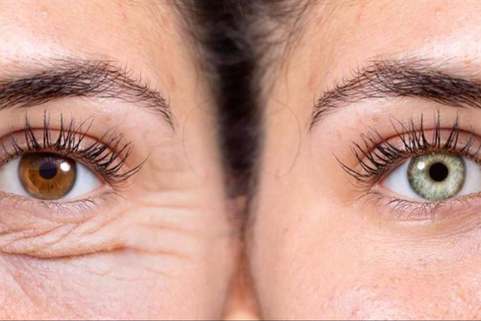 Clínica Eyecos transforma miradas con la blefaroplastia láser y el cambio de color de ojos