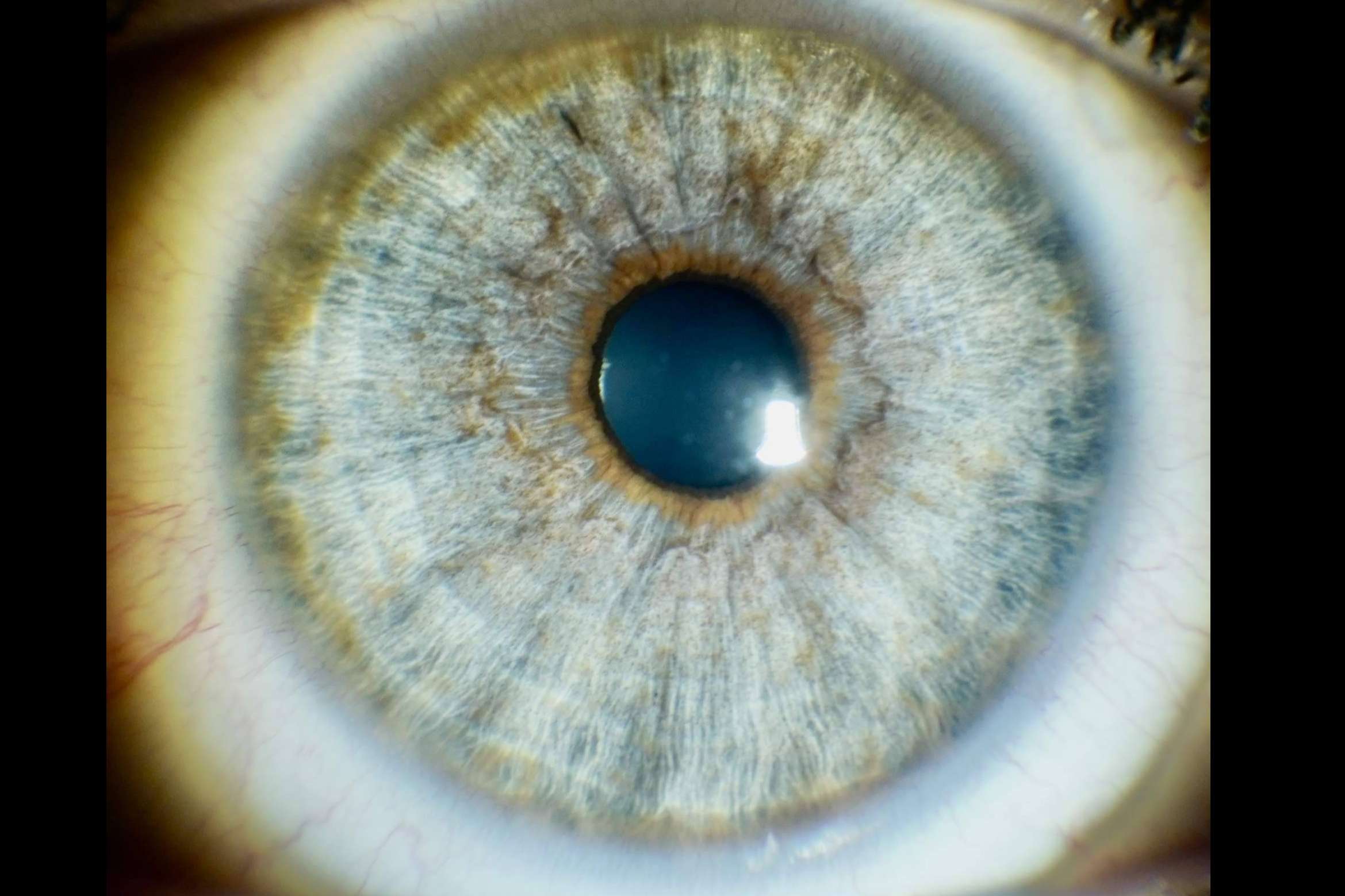 Las preguntas más frecuentes sobre el láser para cambiar el color de ojos en Eyecos