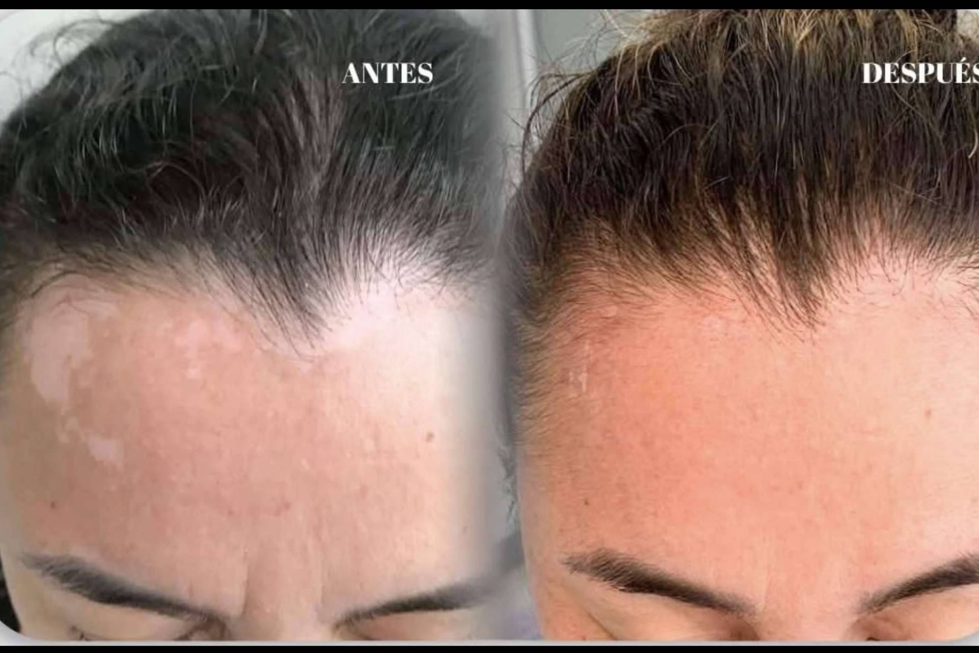 Clínica God Bless fortalece su especialización en vitiligo con la terapia combinada de la Dra. Janeth Arévalo