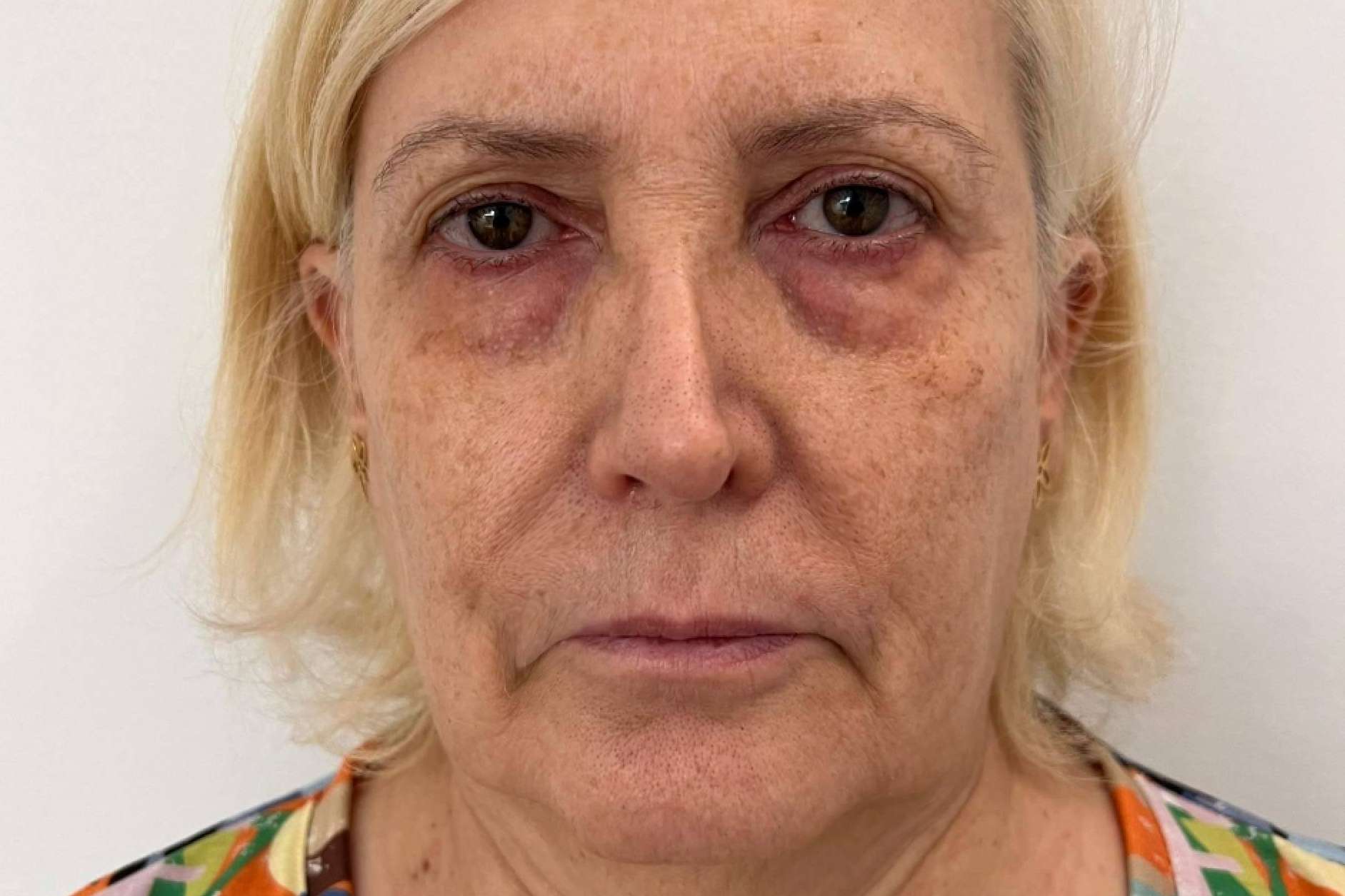 Rejuvenecimiento facial en MD Cliniques; la revolución de SEFFILLER®️ y la regeneración celular autóloga