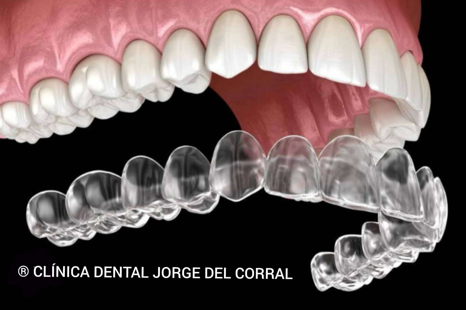 Ortodoncia invisible con tecnología digital; la apuesta de la Clínica Dental Jorge del Corral en Hortaleza, Madrid