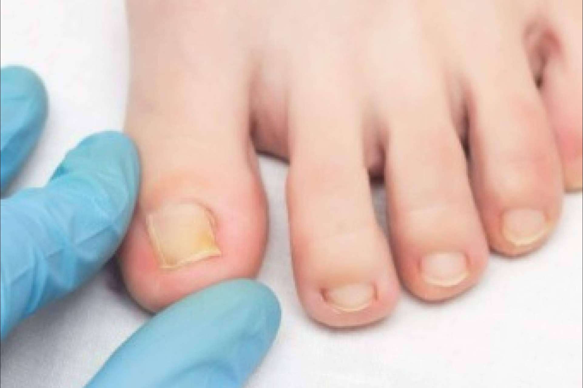 La micosis cutánea en verano; factores de riesgo y tratamientos eficaces