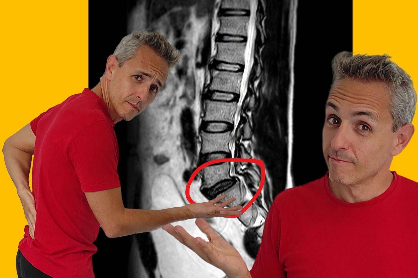 Roberto Galván explica cuál es el enfoque más eficaz para el tratamiento de la hernia discal L5-S1