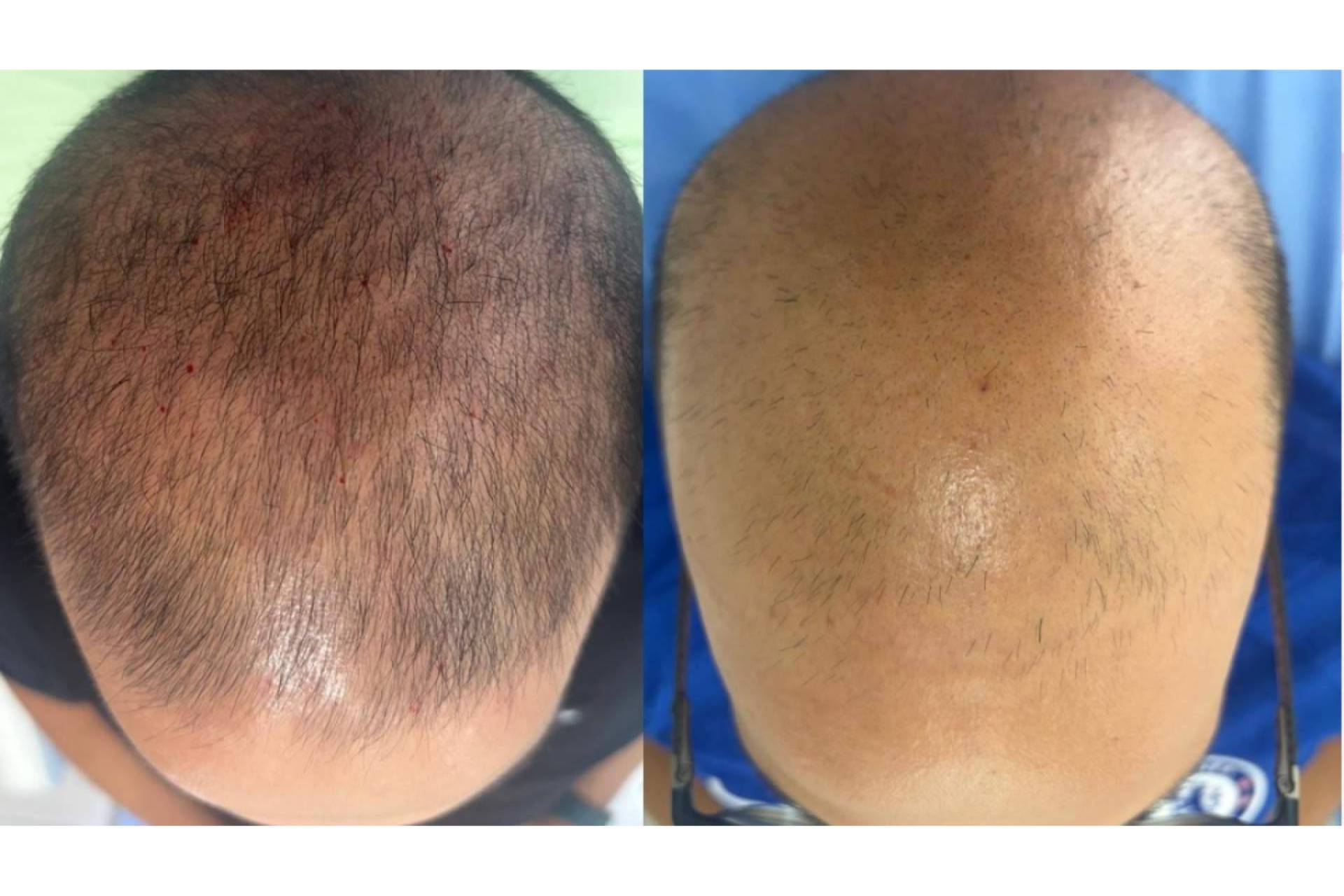 Dra. Janeth Arévalo analiza las nuevas tendencias en el tratamiento de la alopecia androgenética para 2027